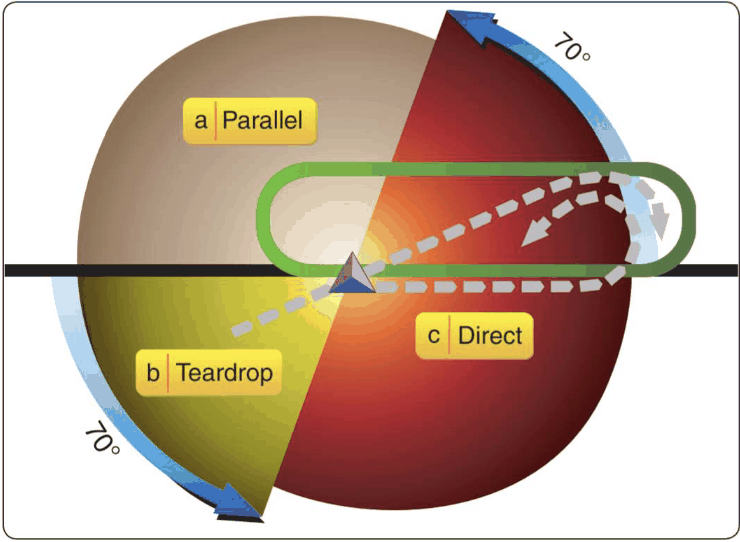 hold pattern with the 70° pen overlay across the fix, showing the three sectors (180° direct, 110° parallel, 70° teardrop) with arrows for each entry type's procedure